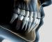 implant-tedavi-sureci