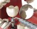 implant-tedavisi-macros-implant (1)